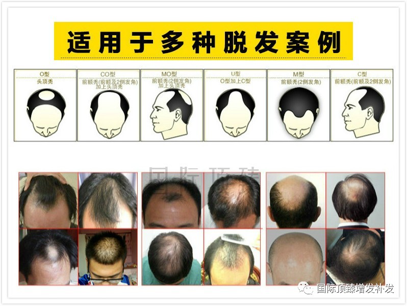 北京市脱发头发稀少国际顶臻医美增发补发厂家